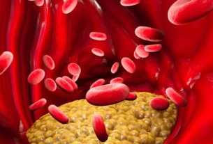 Familial Chylomicronemia Syndrome (FCS) Treatment