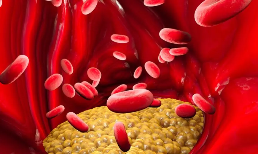 Familial Chylomicronemia Syndrome (FCS) Treatment